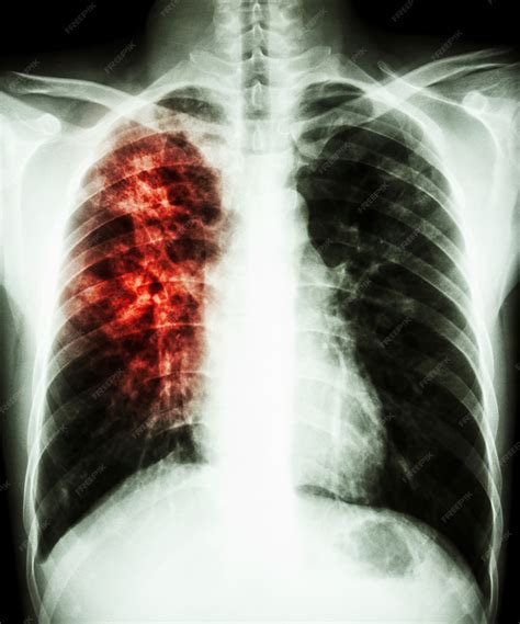 infiltração no pulmão